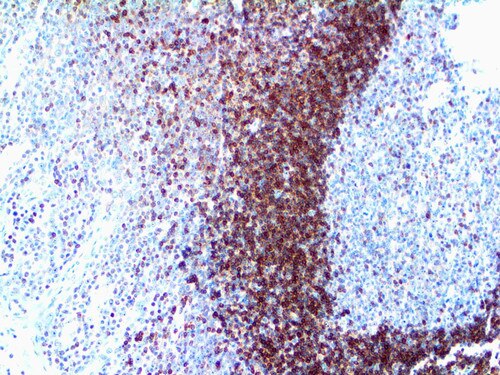 IHC of Bcl-2 on an FFPE Tonsil Tissue